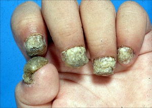 Candida of the nails